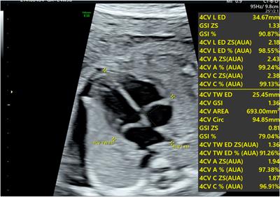 Quantifying fetal heart health in gestational diabetes: a new approach with fetal heart quantification technology